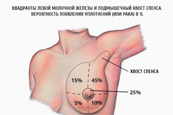 Kairiosios krūtinės kvadrantės ir spenio aksialinė spence.  Riešutų tikimybė (ar vėžys)%