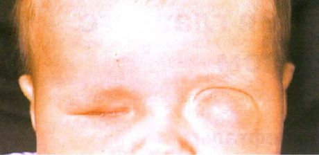 Mikroplazis su kartu formuojančia cista (kairoji akis).  Anoftalmas (dešinoji akis).