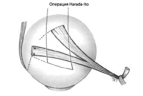 Strabizmas - operacija