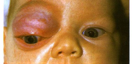 Kapiliarinė hemangioma priekinėje orbitos dalyje ir viršutiniame akies vokelyje.  Neoplazma linkusi į pažangą