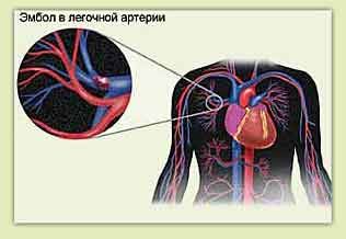 Plaučių embolija ir krūtinės skausmai kairėje