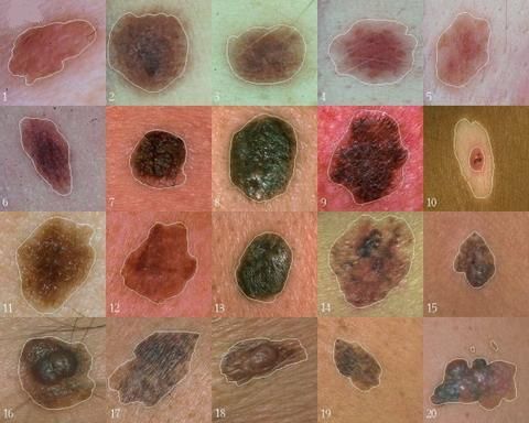 Mokslininkai atrado geną, kuris vaidina pagrindinį vaidmenį plečiant melanomą