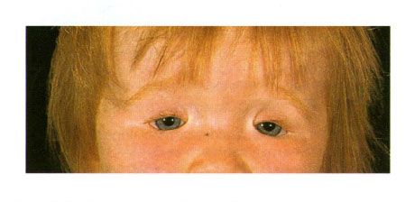 Vaikų su aukso sindromu dvišalė akies vokų koloboma.  Akies plyšio uždėjimas kairėje